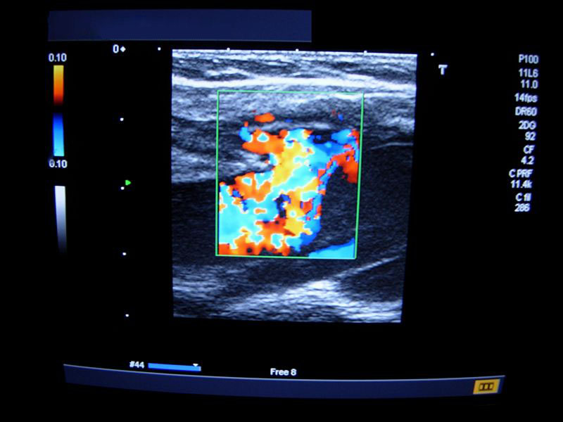 Ecocolordoppler