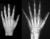 Radiografia del polso e della mano sinistra per lo studio dell’Età Ossea